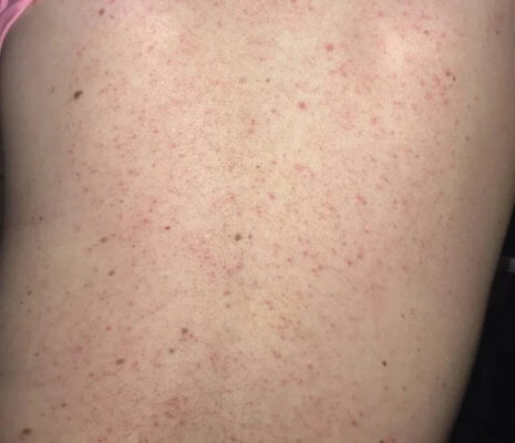 Cach Tri Viem Nang Long Hieu Qua Tai Nha (3)